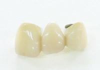 硬質レジン前装冠