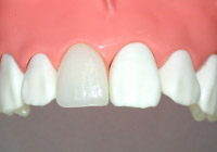 メタルボンドクラウン