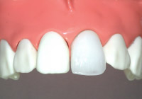 ジルコニアセラミッククラウン