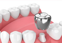 金銀パラジウム合金クラウン