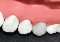 メタルボンドクラウン