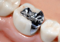 金銀パラジウム合金詰め物