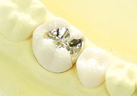 ゴールド詰め物